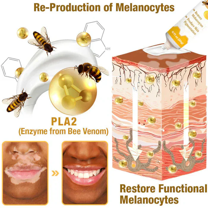 Bee Venom Vitigo Correcting Cream - (Pack of 2)